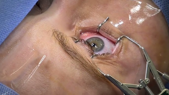 CIRURGIA REFRATIVA - DR RENATO AMBRÓSIO