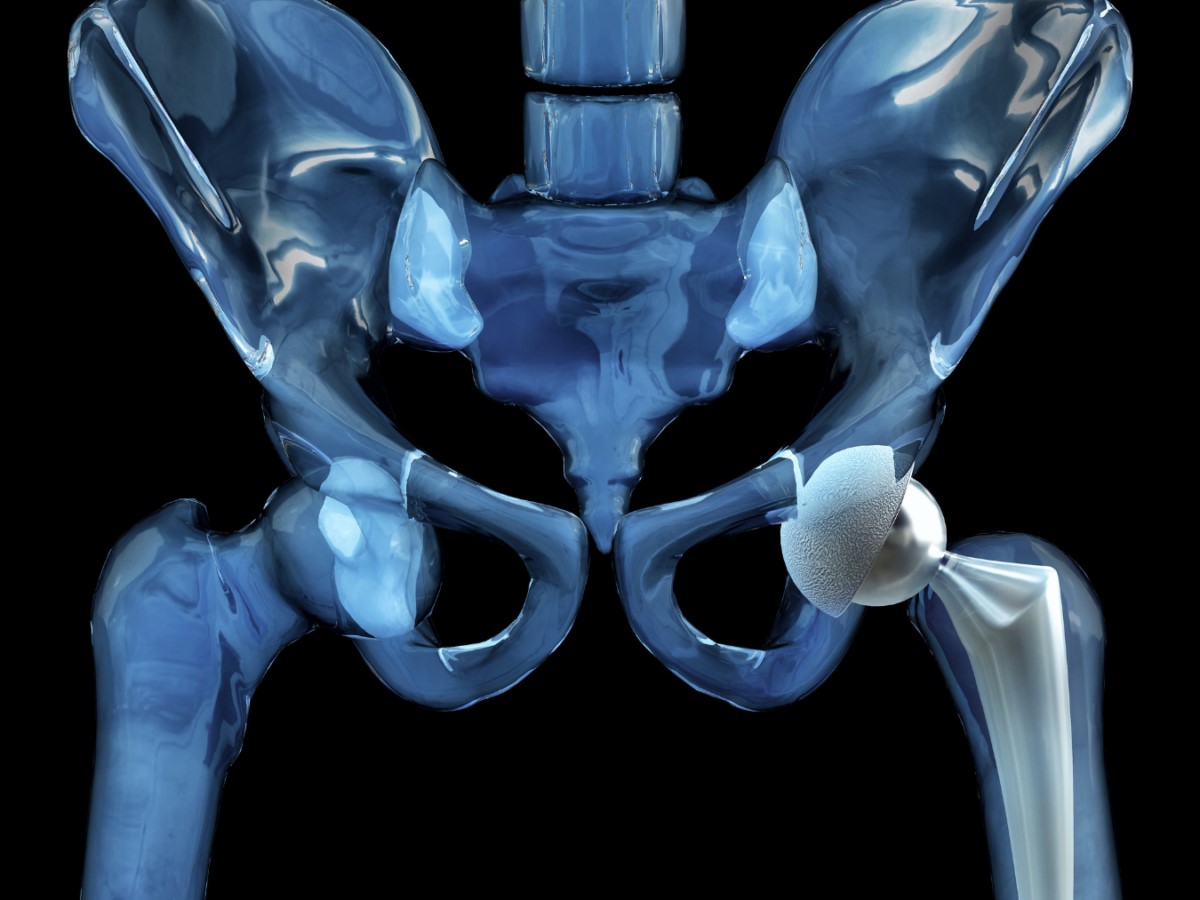 Cirurgia do Quadril - Dr Arlindo Ricon